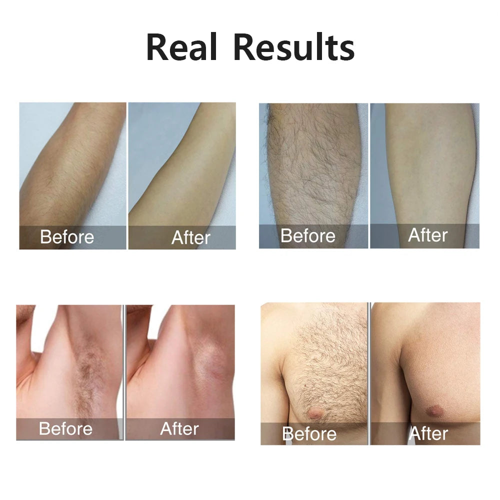 Ovira IPL™ Hair Removal Device
