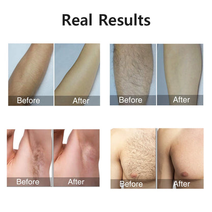 Ovira IPL™ Hair Removal Device