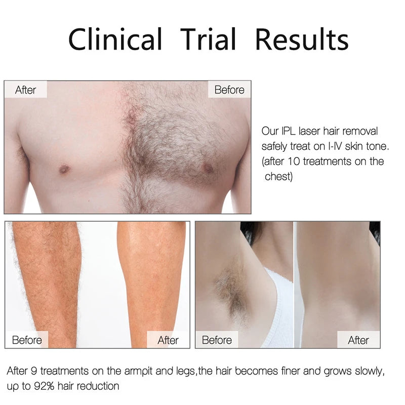 Ovira IPL™ Hair Removal Device
